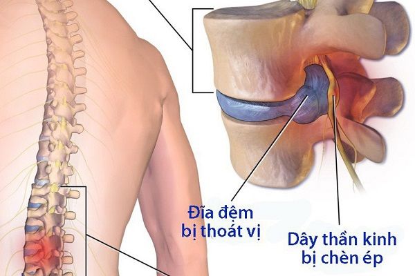 thoát vị đĩa đệm là gì
