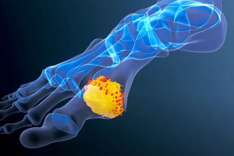 Cần làm gì khi bị Gout?