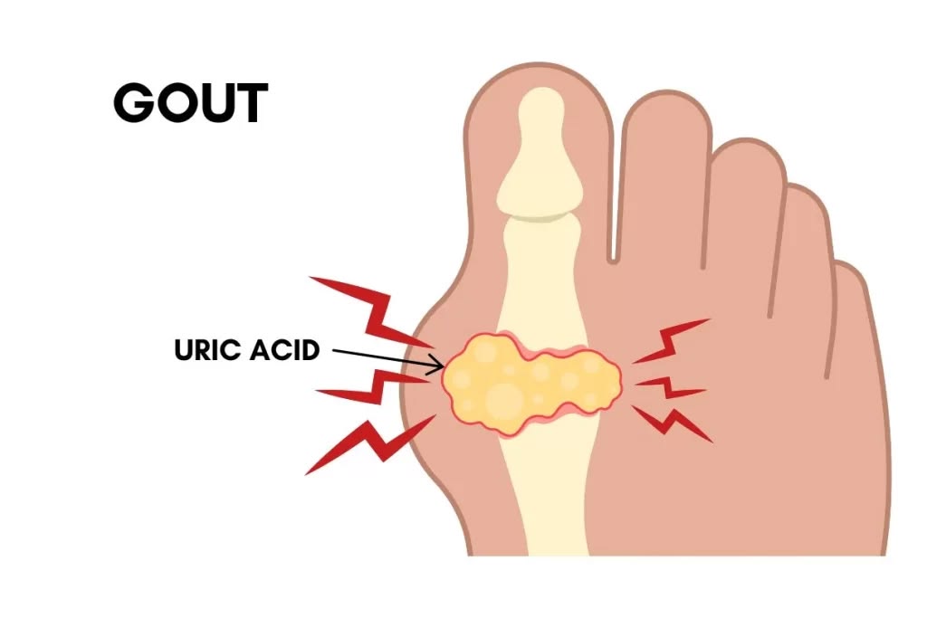 Nhận biết 7 dấu hiệu bị gout sớm