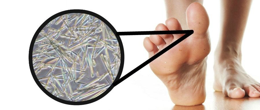 Nhận biết 7 dấu hiệu bị gout sớm