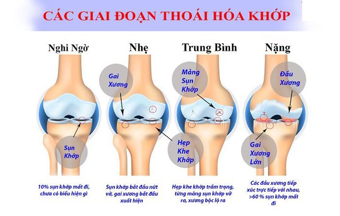 4 giai đoạn thoái hóa khớp gối
