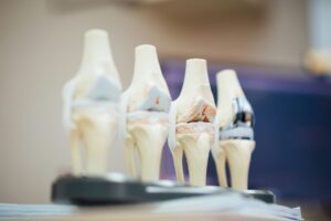 Thoái hóa khớp gối: 4 giai đoạn và phương pháp điều trị không phẫu thuật