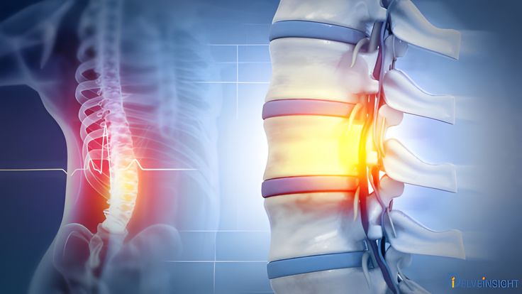 Bị Thoát Vị Đĩa Đệm Có Nên Đi Bộ Không?
