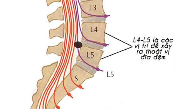 Thoát Vị Đĩa Đệm Cột Sống Thắt Lưng