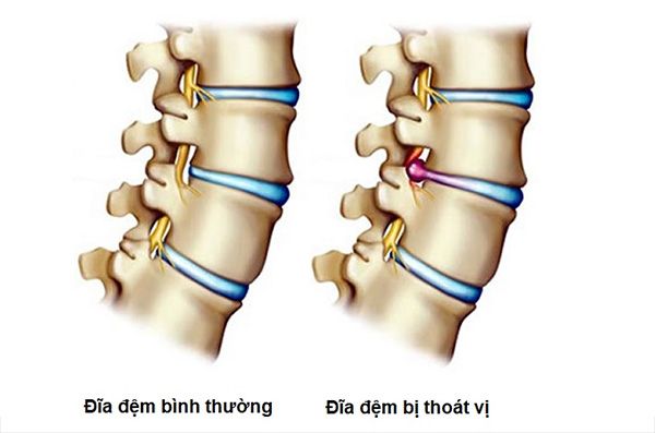 Điều Trị Thoát Vị Đĩa Đệm Tại Hà Nội Uy Tín