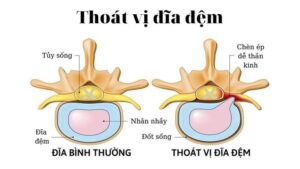 Điều Trị Thoát Vị Đĩa Đệm Tại Hà Nội Uy Tín