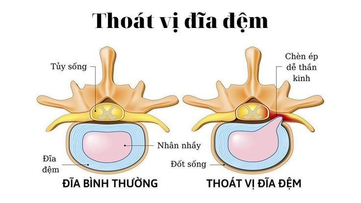 Điều Trị Thoát Vị Đĩa Đệm Tại Hà Nội Uy Tín